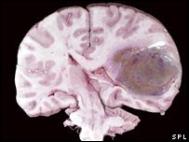 Tumor_cerebral